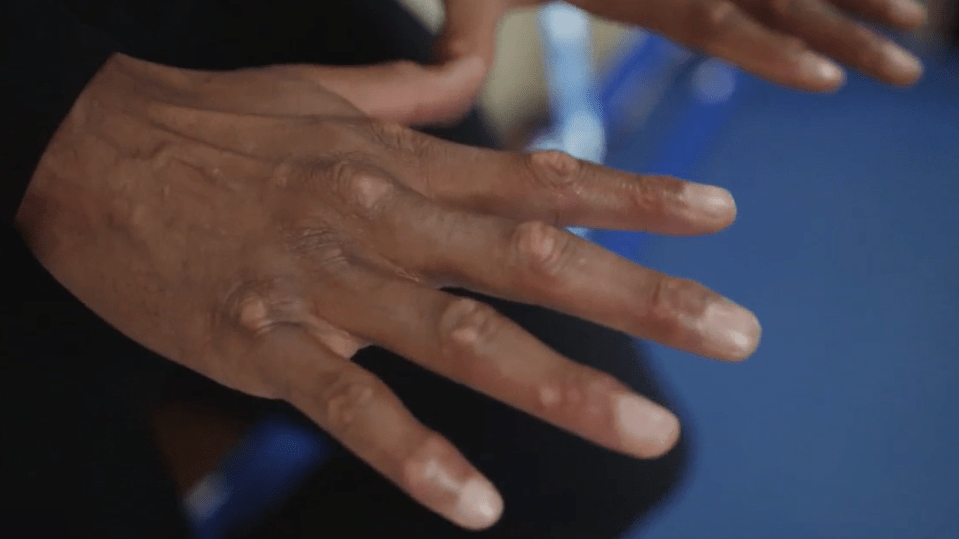 Anthony Joshua shows off gruesome scars on his knuckles after ‘fighting six guys on his own instead of getting chicken’