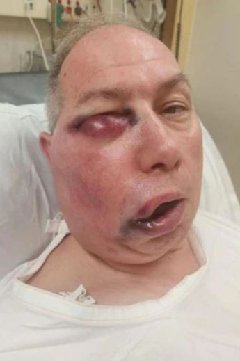 Cricket umpire left unrecognisable with horror facial injuries but says he ‘feels like he won lottery’